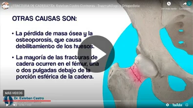 Fractura de Cadera Dr. Esteban Castro Contreras - Traumatólogo y Ortopedista