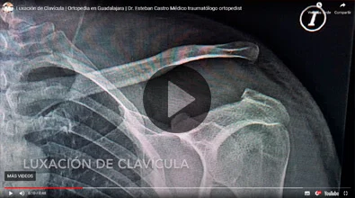 Luxación de Clavícula Dr. Esteban Castro Contreras - Traumatólogo y Ortopedista
