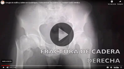 Cirugía rodilla y cadera Dr. Esteban Castro Contreras - Traumatólogo y Ortopedista